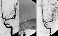 Abbildung 5: A. carotis interna - Stent
