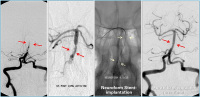 Abbildung 7: A. basilaris - Stent