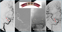 Abbildung 8: Arteria carotis  interna - Stent