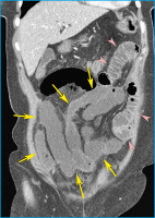 Abbildung 1C: CT-Rekonstruktion in koronaler Ebene
