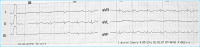 Abbildung 1: Sinusrhythmus