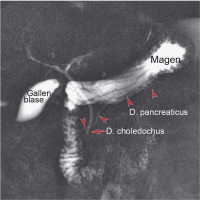 Abbildung 1a: Ductus choledochus