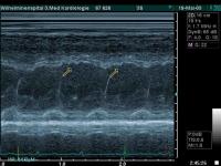 Abbildung 1: Pericarditis constrictiva