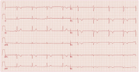 Abbildung 1: EKG