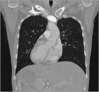 Abbildung 3: CT-Thorax