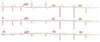 Abbildung 4: EKG