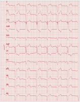 Abbildung 5: EKG