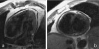 Abbildung 6a-b: Pericarditis constrictiva
