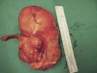 Abbildung 2: Tumor - Appendix