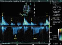 Abbildung 2: Transmitrale CW-Dopplerregistrierung