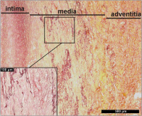 Abbildung 1: Aortenaneurysma