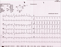 Abbildung 1: EKG