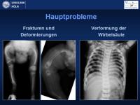 Abbildung 4: Osteogenesis imperfecta