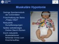 Abbildung 6: Osteogenesis imperfecta