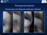 Abbildung 12: Osteogenesis imperfecta