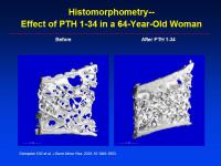 Abbildung 67: Osteoporose