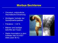 Abbildung 2: Morbus Bechterew