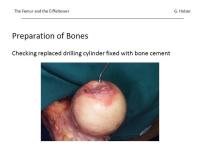 Abbildung 19: Osteoporose