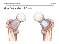 Abbildung 20: Osteoporose