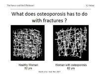 Abbildung 33: Osteoporose
