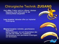 Abbildung 43: Osteoporotische Fraktur