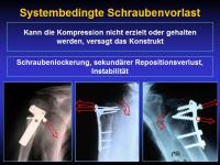 Abbildung 48: Osteoporotische Fraktur