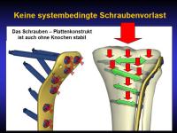 Abbildung 52: Osteoporotische Fraktur