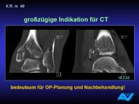 Abbildung 75: Osteoporotische Fraktur