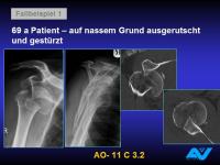 Abbildung 79: Osteoporotische Fraktur