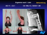 Abbildung 83: Osteoporotische Fraktur