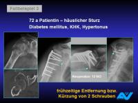 Abbildung 84: Osteoporotische Fraktur