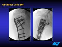 Abbildung 88: Osteoporotische Fraktur
