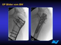 Abbildung 91: Osteoporotische Fraktur