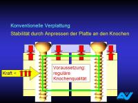 Abbildung 114: Osteoporotische Fraktur