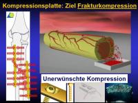 Abbildung 115: Osteoporotische Fraktur