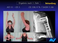 Abbildung 118: Osteoporotische Fraktur