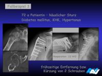 Abbildung 119: Osteoporotische Fraktur