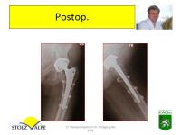 Abbildung 16: Osteoporotische Refraktur