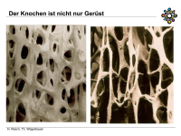 Abbildung 4: Osteoporose