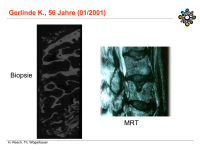 Abbildung 11: Osteoporose