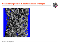 Abbildung 17: Osteoporose