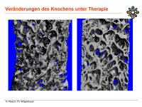 Abbildung 18: Osteoporose