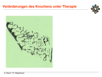 Abbildung 19: Osteoporose