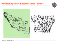 Abbildung 20: Osteoporose