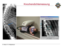 Abbildung 22: Osteoporose