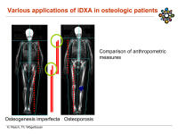 Abbildung 25: Osteoporose