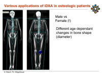 Abbildung 26: Osteoporose