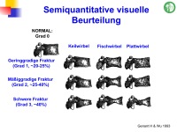 Abbildung 68: Frakturrisiko - �sterreich