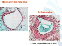 Abbildung 5: COPD - Osteoporose