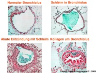 Abbildung 6: COPD - Osteoporose